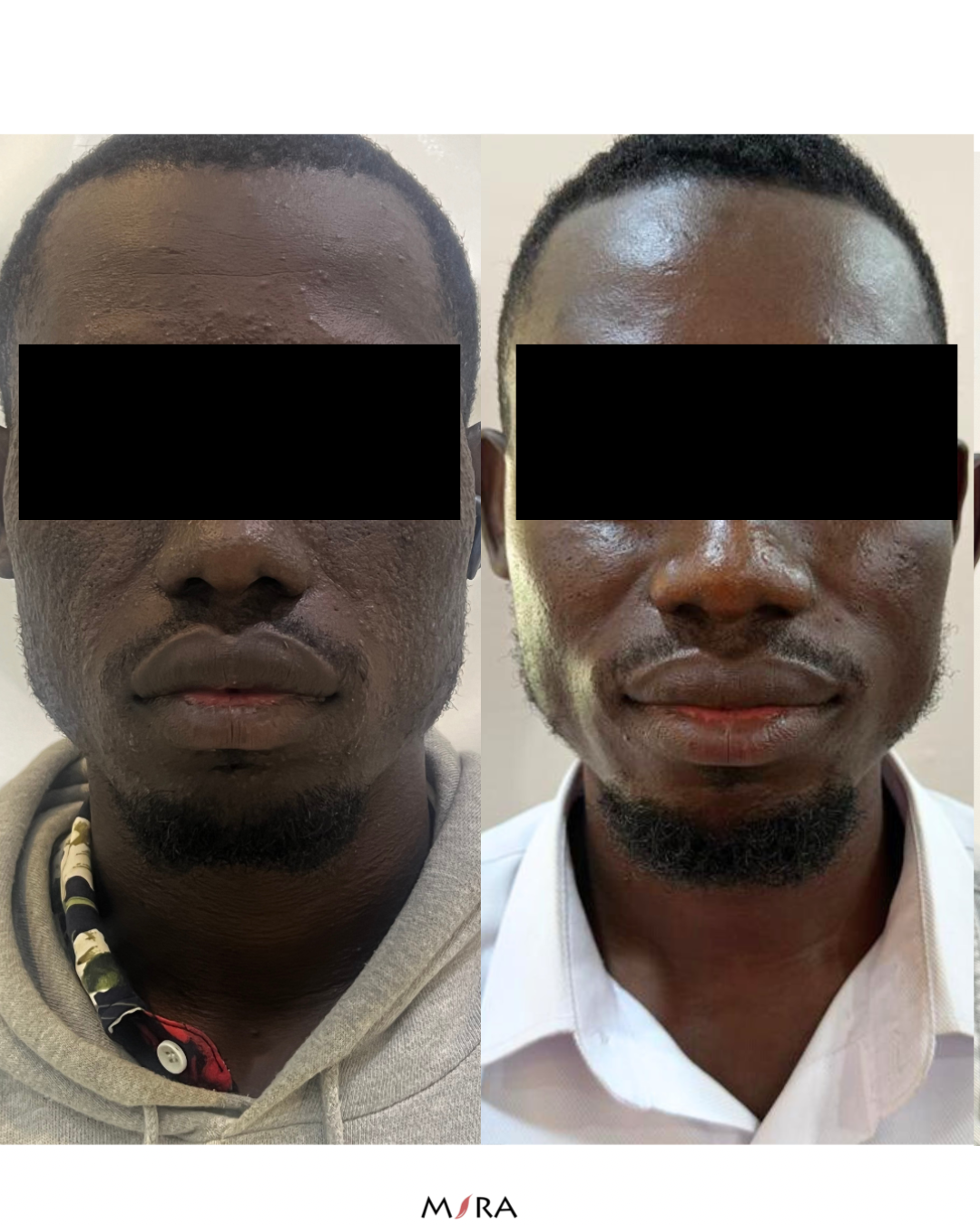 Acne treatment procedure on Black woman